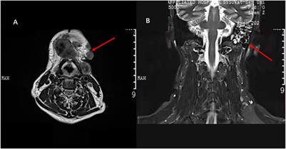 Case Report: Good cardiac tolerance to Toripalimab in a CVD patient with oral melanoma